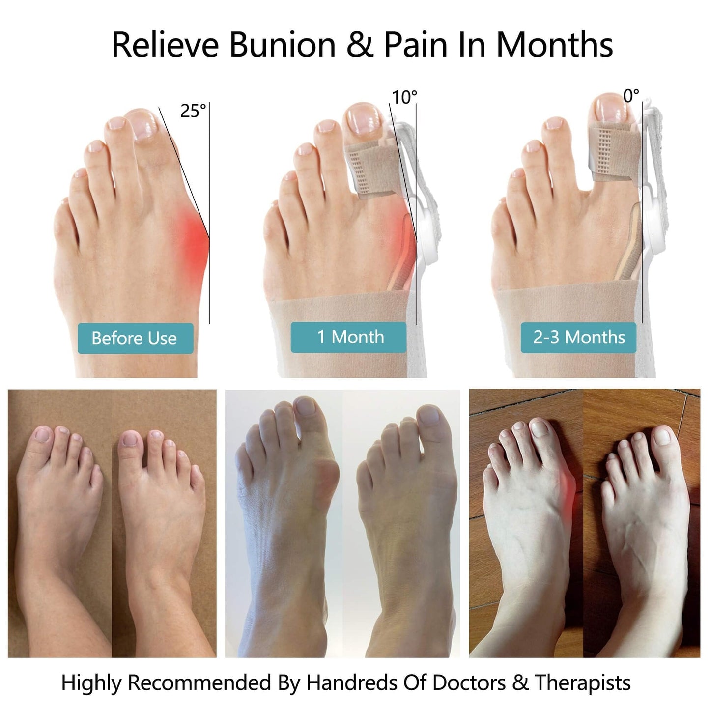 š„Big Promotion 49% OFFš„Orthopedic Bunion Corrector